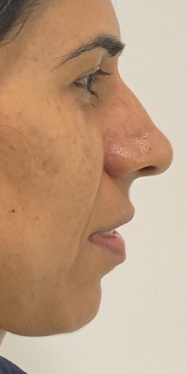 Dermal Fillers Before treatment at Dexa Clinic